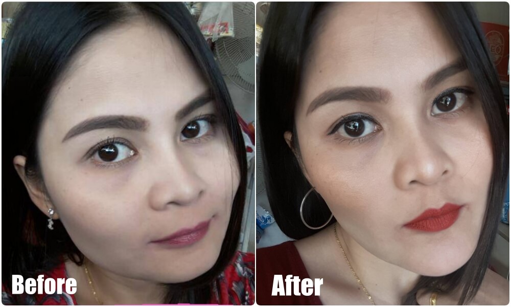 before-after-chin-surgery-phuket