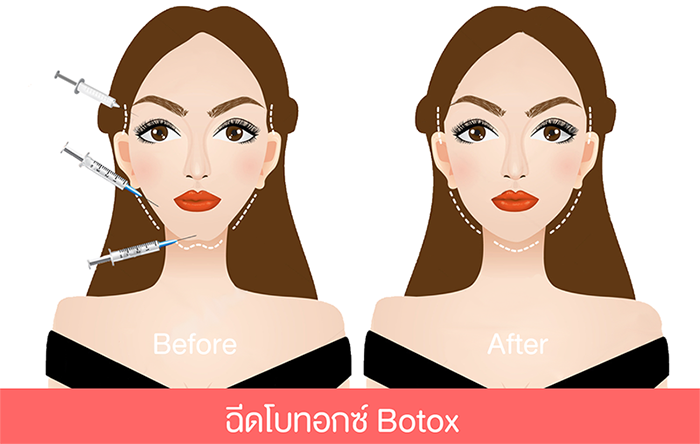 ฉีดโบท็อกซ์ botox กับฟีร์บิวตี้คลินิกภูเก็ต Phuket