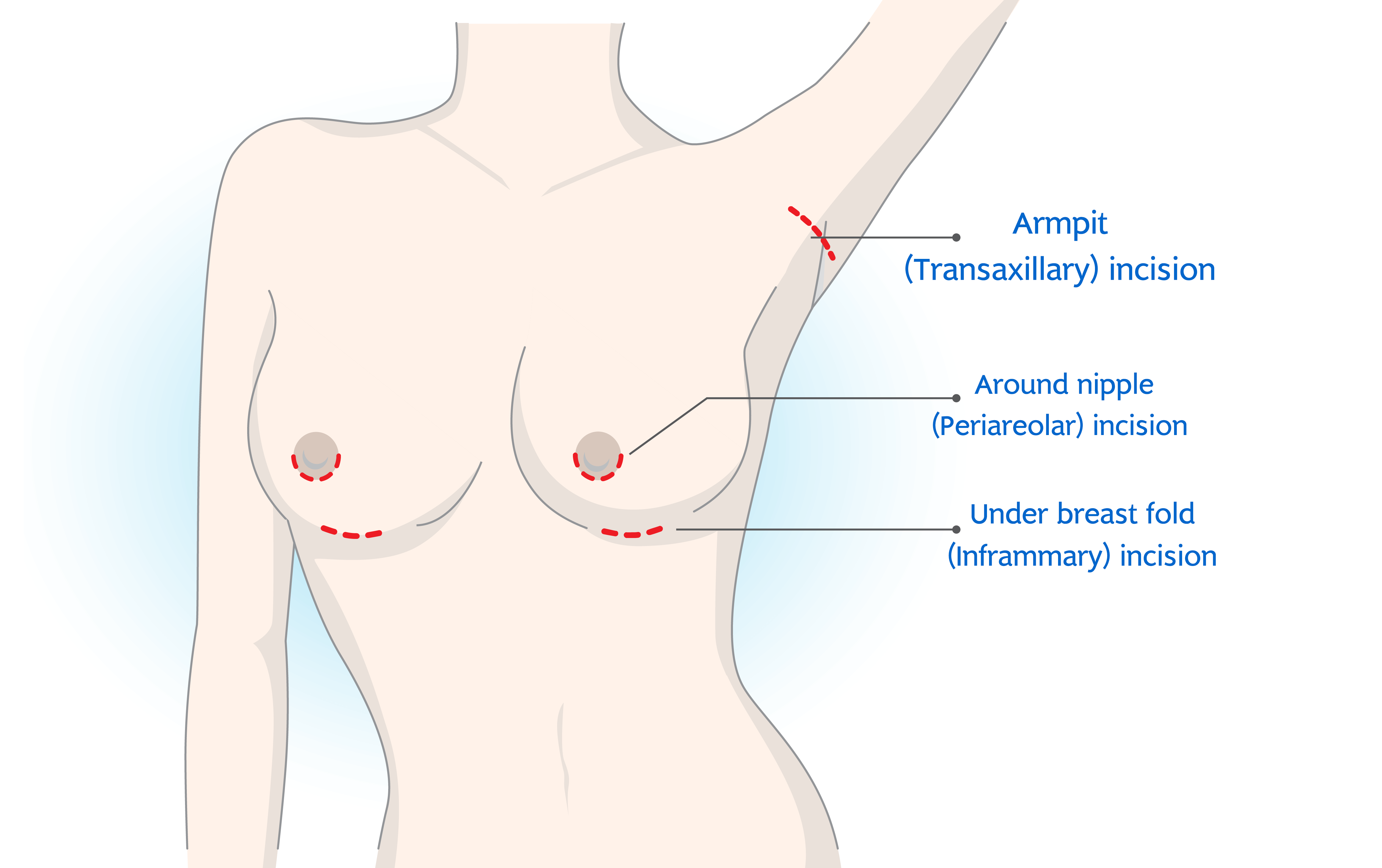 Position of the Incision