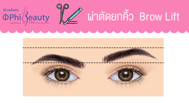 ผ่าตัดยกคิ้ว Brow Lift