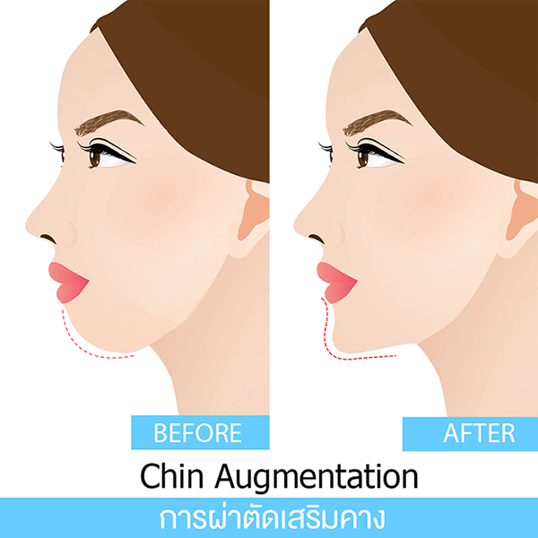 ผ่าตัดเสริมคาง Chin Augmentation