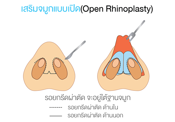 การผ่าตัดเสริมจมูกแบบเปิด สร้างปลายจมูกใหม่ ให้ดูมีหยดน้ำที่ปลายจมูก