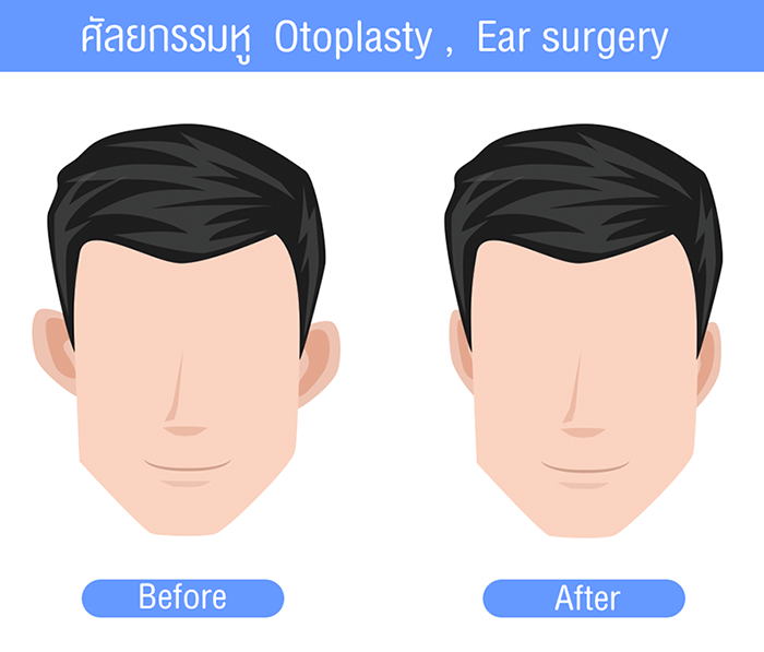 การผ่าตัดศัลยกรรมแก้ไขหูกาง
