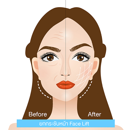 ผ่าตัดดึงหน้าหรือยกกระชับหน้า face lift