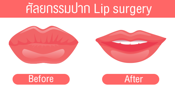 ทำปากบาง, ปากกระจับ, Lip surgery