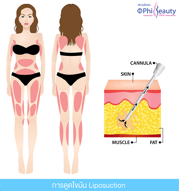 บริเวณที่สามารถดูดไขมันได้, area can liposuction