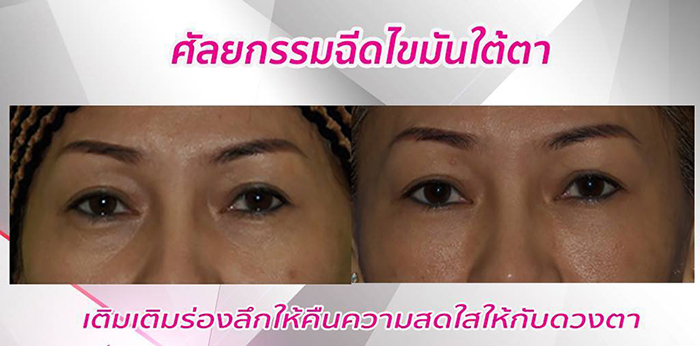 รีวิวฉีดไขมันใต้ตา เติมร่องลึกให้คืนความสดใสให้กับดวงตา