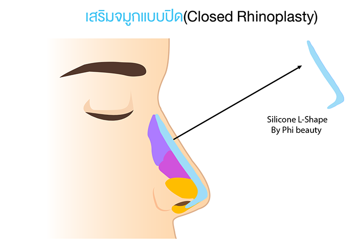 การเสริมจมูกแบบปิด Silicone L-Shape เสริมจมูกแบบปิดและตกแต่งปีกจมูก