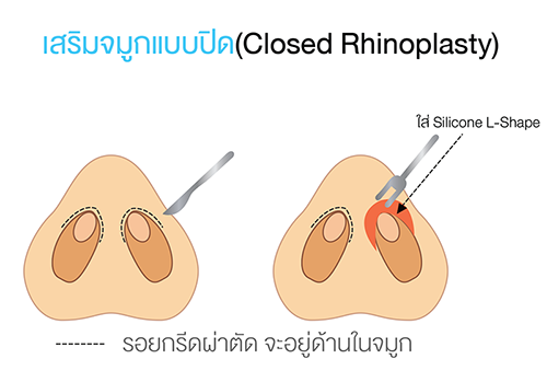 การผ่าตัดปีกจมูกไปพร้อมกันกับการผ่าตัดเสริมจมูก