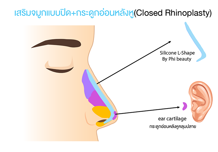 เสริมจมูกแบบปิดร่วมกับการใส่กระดูกอ่อนหลังหู