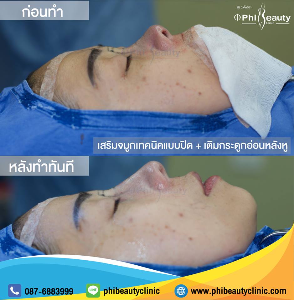 รีวิวเสริมจมูกภูเก็ต เสริมจมูกปลายหยดน้ำ เสริมจมูกแบบเปิด