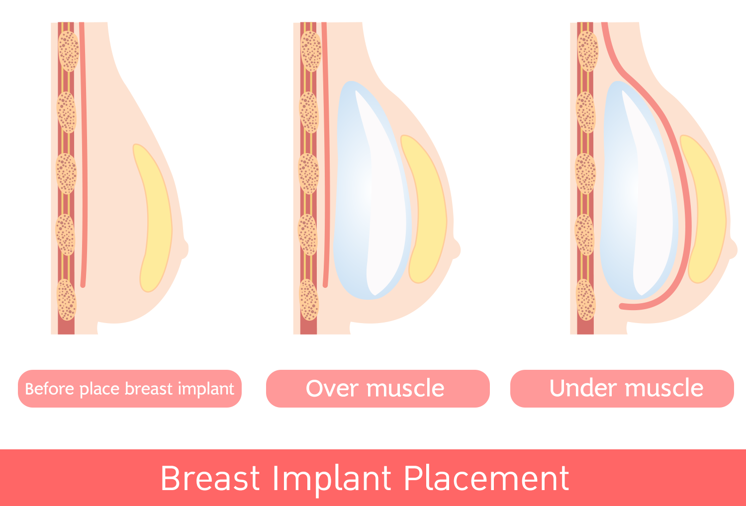 Breast Incision: Inframammary incision or under breast, Transaxillary and Periareolar