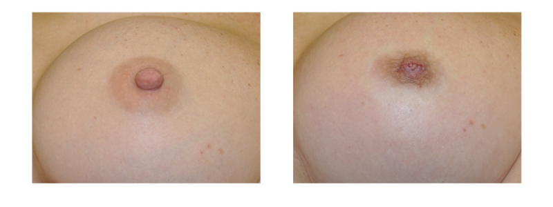 Areola Reshaping Surgery, Nipple Reduction Surgery, Nipple